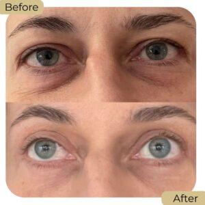 under eye fillers before after