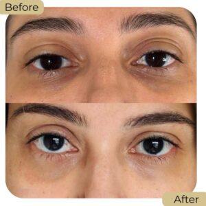 under eye fillers in islamabad