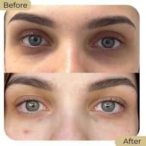 under eye fillers in islamabad rawalpindi