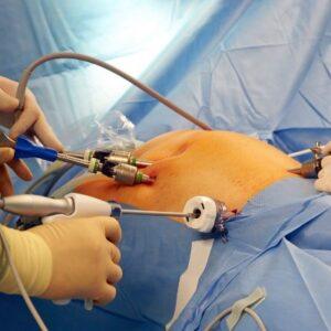 Can Bariatric Surgery in Islamabad Reduce Weight Fast