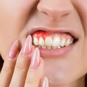 Can Pinhole Surgery Replace Gum Grafting