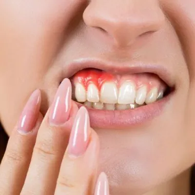 Can Pinhole Surgery Replace Gum Grafting?
