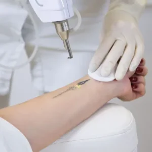 Can a 20-year-old tattoo be completely removed in Islamabad
