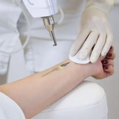 Can a 20-year-old tattoo be completely removed in Islamabad?