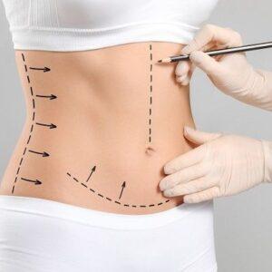 Can a Tummy Tuck Tighten Loose Skin