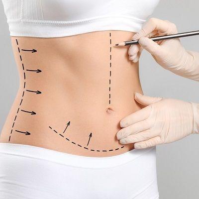Can a Tummy Tuck Tighten Loose Skin