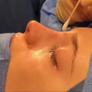 Can rhinoplasty correct nose width in Islamabad