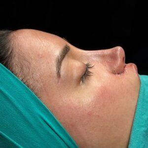 Does Rhinoplasty Help With Snoring