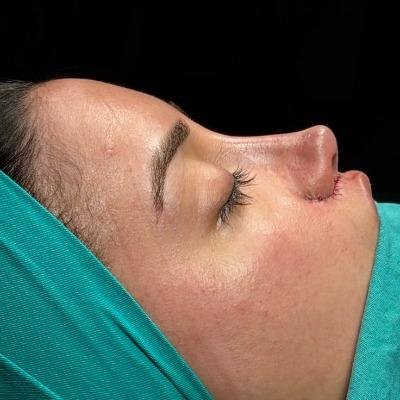 Does Rhinoplasty Help With Snoring?