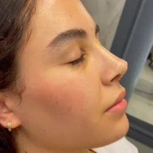 How many days of rest are required after rhinoplasty