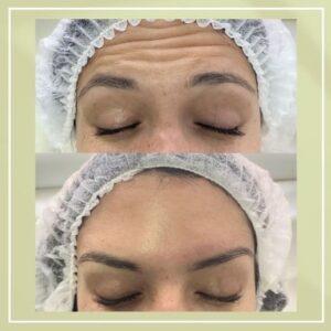 Is Botox a Fast Beauty Treatment