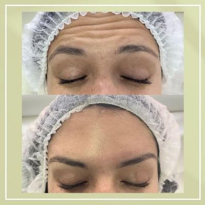 Is Botox a Fast Beauty Treatment?