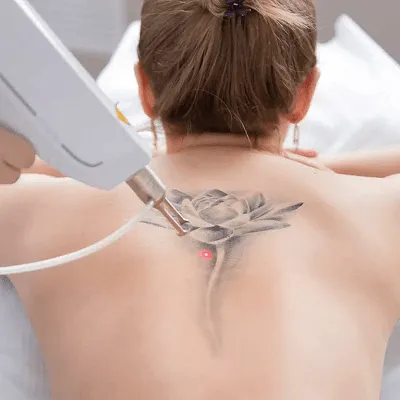Is Tattoo Removal Safe for Sensitive Skin?