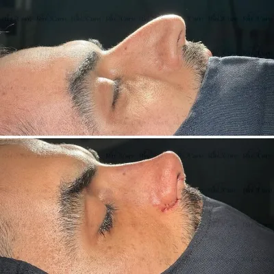 Is rhinoplasty 100% safe?