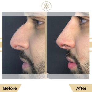 Rhinoplasty for men in islamabad