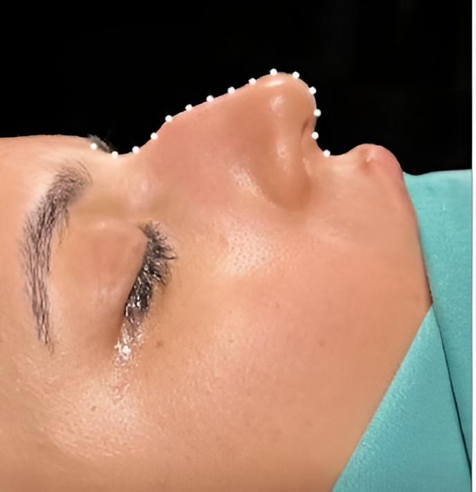 Rhinoplasty vs Liquid Rhinoplasty: Which Lasts Longer?