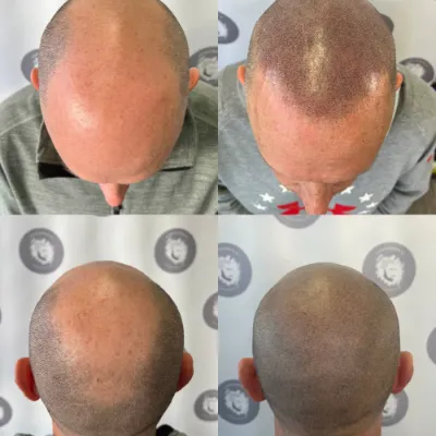 Scalp Micropigmentation in Islamabad