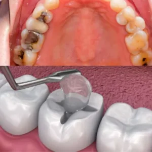 Tooth Filling Cost in Islamabad
