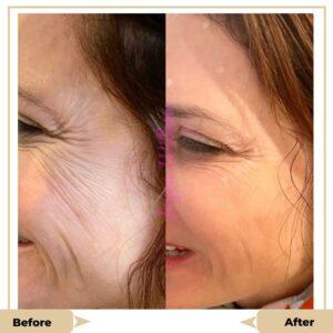 Virtue RF Micro needling treatment