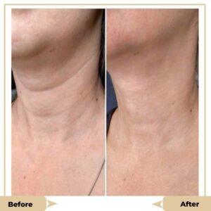 Virtue RF Micro needling treatment islamabad