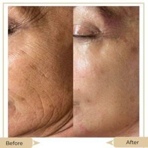Virtue RF Micro needling treatment rawalpindi islamabad