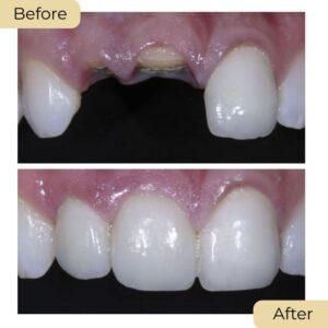 dental crown before after