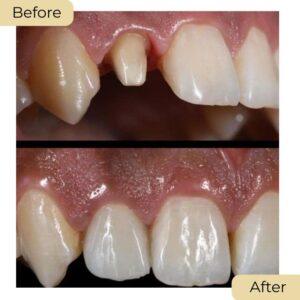 dental crown in islamabad