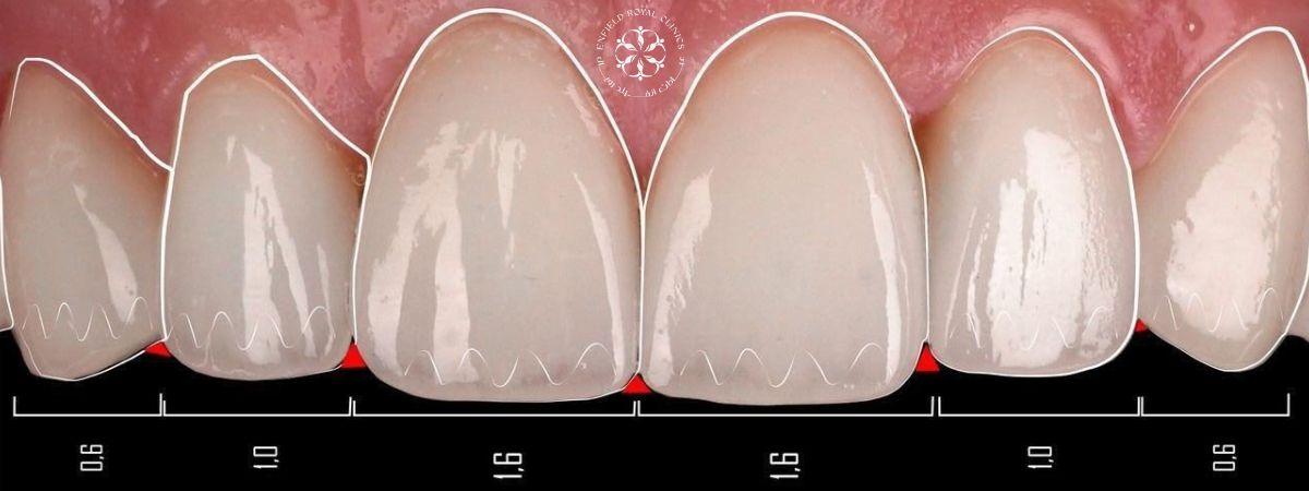 dental crown in islamabad image
