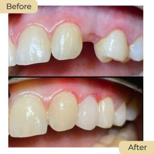 dental crown treatment in islamabad