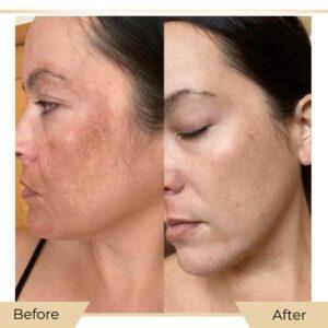 dermal pigmentation before after