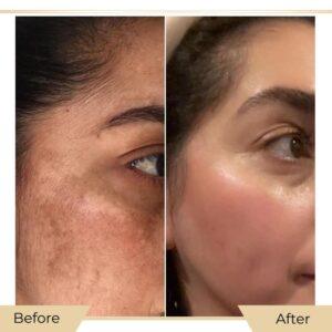 dermal pigmentation cost in islamabad