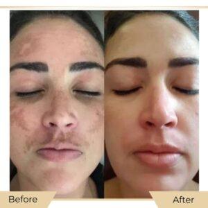 dermal pigmentation in islamabad