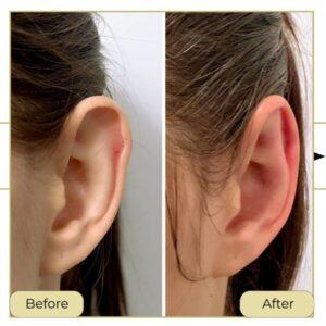ear reshaping surgery in islamabad