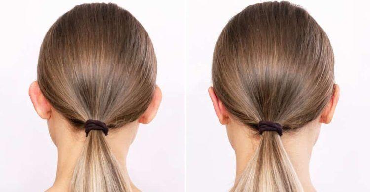 ear reshaping surgery in islamabad before after