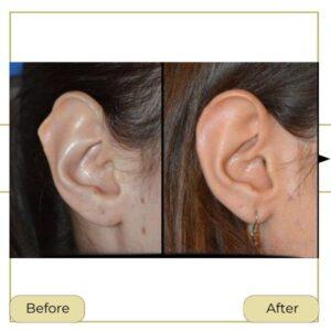 ear reshaping surgery in islamabad rawalpindi