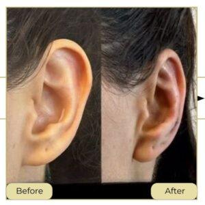ear reshaping surgery in islamabad rawalpindi islamabad