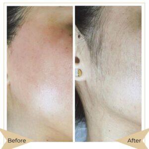 laser hair removal before after