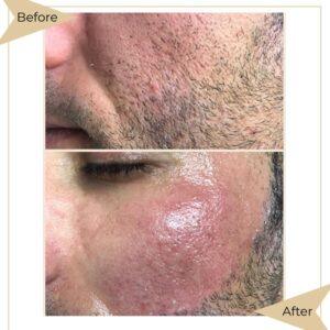 laser hair removal in islamabad rawalpindi islamabad