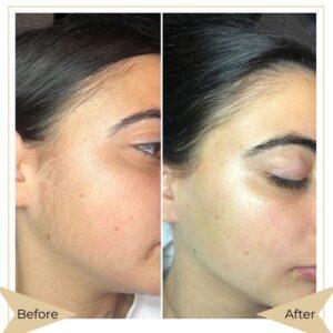 laser hair removal islamabad