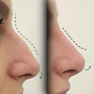 nose surgery in islamabad f6 f7 area