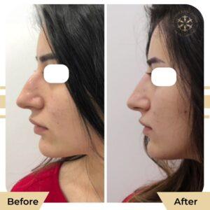 rhinoplasty before after in islamabad