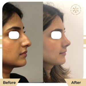 rhinoplasty in islamabad