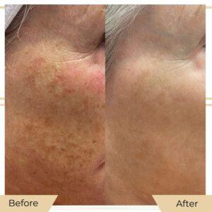 skin pigmentation in islamabad