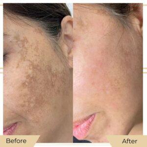 skin pigmentation in islamabad rawalpindi