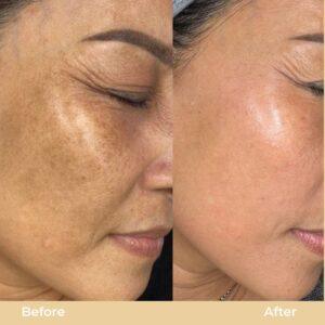skin pigmentation islamabd rawal[indi
