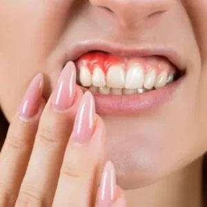 Can Gum Grafting in Islamabad Protect Your Teeth