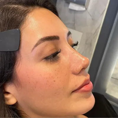Does Nose Tip Plasty in Islamabad Leave Scars?