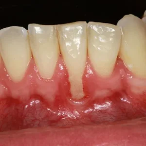 Is Gum Grafting a Permanent Solution