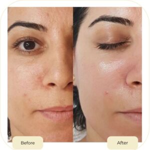 chemical peel treatment in islamabad