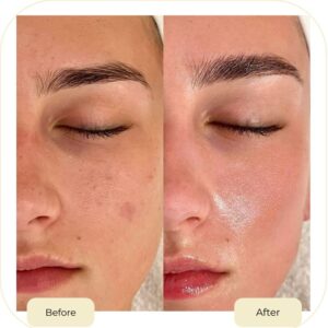 chemical peel treatment in islamabad after before